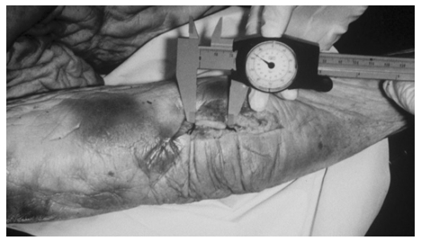 Figure 3. Effet d’une séquence neurodynamique lors d’une mise en tension du nerf cubital au niveau du coude (Tsai 1995, Shacklock 2005a, Elsevier, Oxford). Reproduction interdite. DR Figure 3. Effet d’une séquence neurodynamique lors d’une mise en tension du nerf cubital au niveau du coude (Tsai 1995, Shacklock 2005a, Elsevier, Oxford). Reproduction interdite. DR