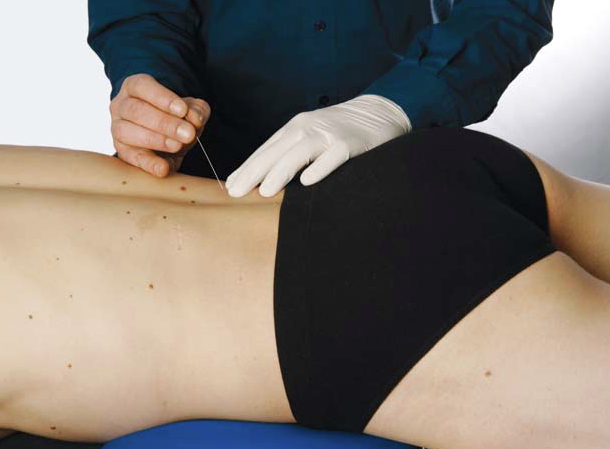 Dry Needling - Top 30 Dry Needling - Top 30