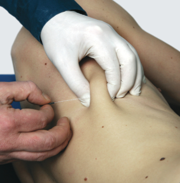 Dry Needling - Cours avancé Quadrant supérieur Dry Needling - Cours avancé Quadrant supérieur